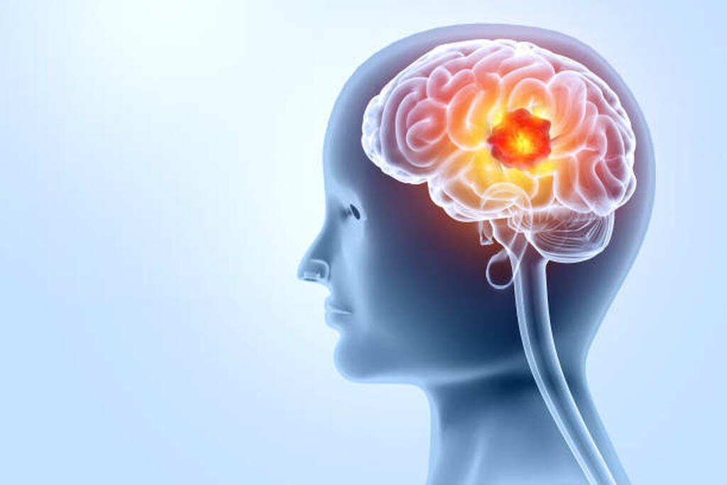 Best Brain Tumour Specialist In Mumbai